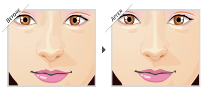Nâng mũi S line sửa mũi cong vẹo hiệu quả