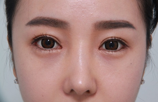 Bấm mí mắt Hàn Quốc giữ được bao lâu